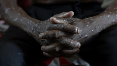 India Menemukan Kasus Mpox yang Diduga Dibawa oleh Seorang Pelancong